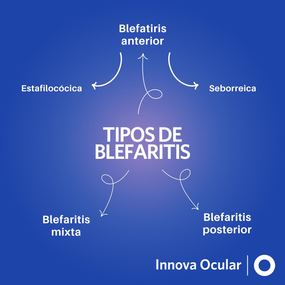 IOcular's tweet image. La #Blefaritis se trata de la inflamación, irritación, escozor y enrojecimiento de los párpados. Esta patología puede presentarse de diferentes maneras:
🌐Conoce las posibles causas y tratamientos de la Blefaritis: innovaocular.com/blefaritis-cau…