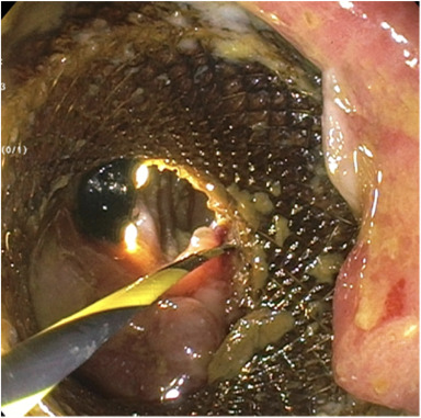 VideoGIE Journal (@videogie) on Twitter photo Michael Jorgensen et al conduct "Endoscopic management of delayed gastrojejunocolic fistula after successful EUS gastrojejunostomy" in this Original Article. videogie.org/article/S2468-…
<a href="/NeilNadparaMD/">Neil Nadpara, MD</a> <a href="/MeeraBhardwajMD/">Meera P. Bhardwaj, MD</a>
<a href="/KaraRaphael/">Kara Raphael</a> Michael Jorgensen et al conduct "Endoscopic management of delayed gastrojejunocolic fistula after successful EUS gastrojejunostomy" in this Original Article. videogie.org/article/S2468-…
<a href="/NeilNadparaMD/">Neil Nadpara, MD</a> <a href="/MeeraBhardwajMD/">Meera P. Bhardwaj, MD</a>
<a href="/KaraRaphael/">Kara Raphael</a>