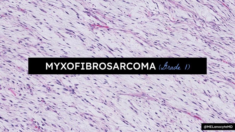 65♀️ w/ thigh mass

💡 ANSWER ➡️ Intramuscular myxoma

🚨 Cannot reliably distinguish from low-grade MFS on biopsy
🦔 Reccomend descriptive dx in limited samples (ex. hypocellular myxoid neoplasm)

WSI
🔷️ IMM: kikoxp.com/posts/50548
🔶️ MFS: kikoxp.com/posts/18776

#bstpath