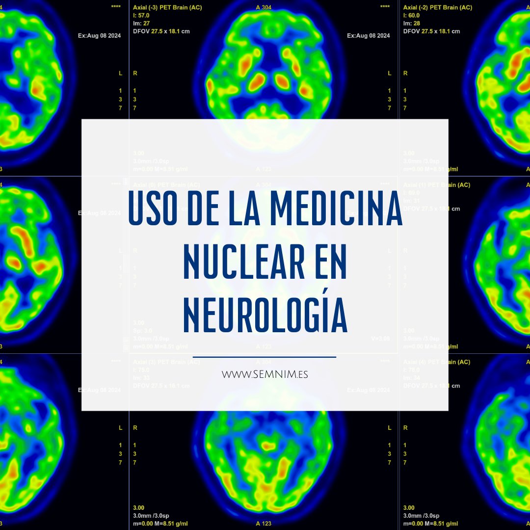 SEMNIMoficial's tweet photo. La #MedicinaNuclear tiene un papel crucial en el diagnóstico de enfermedades neurodegenerativas como el #Alzheimer

¡Descubre cómo estas tecnologías ayudan a cambiar el manejo de estas patologías! 🧵 https://t.co/cElbY2U4e2