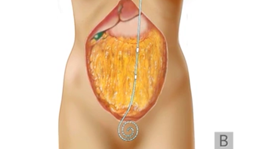 AvelRomanNeph's tweet photo. Cómo realizo la planificación en la colocación del catéter tenckhoff?
🧐
Fuente: https://t.co/N502OwdYqv
#InterventionalNephrology #INFellow #PDFirst https://t.co/P3lokGgOJb