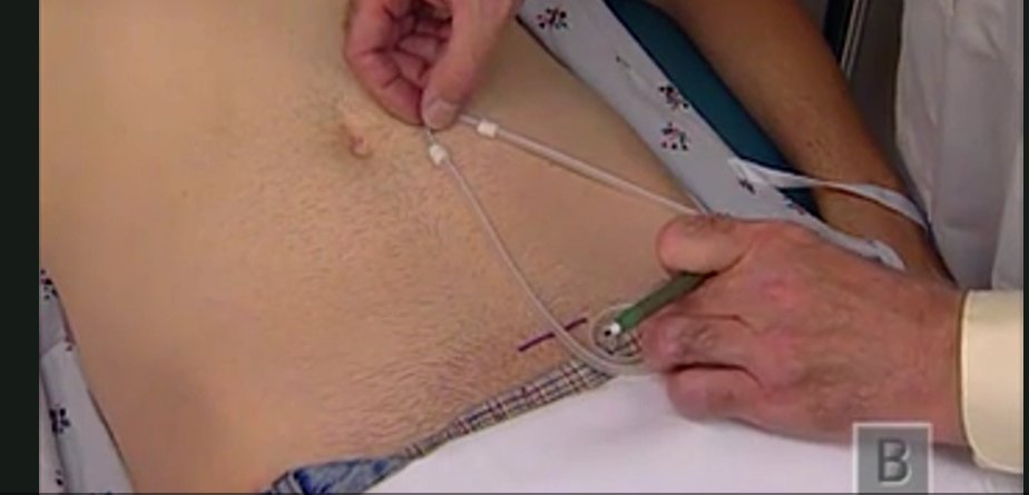 AvelRomanNeph's tweet photo. Cómo realizo la planificación en la colocación del catéter tenckhoff?
🧐
Fuente: https://t.co/N502OwdYqv
#InterventionalNephrology #INFellow #PDFirst https://t.co/P3lokGgOJb