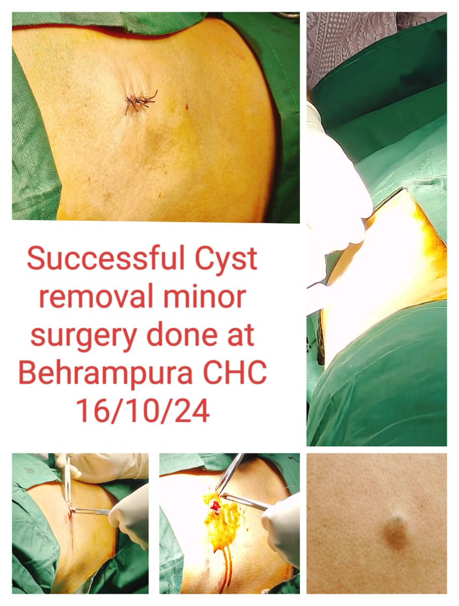 dsbccAmc's tweet image. A successful minor cyst removal surgery was performed today at Behrampura CHC! Our dedicated team continues to provide quality healthcare services to the community. Kudos to all involved! 💙🩺 #HealthcareExcellence #AMC #SurgerySuccess #CommunityCare