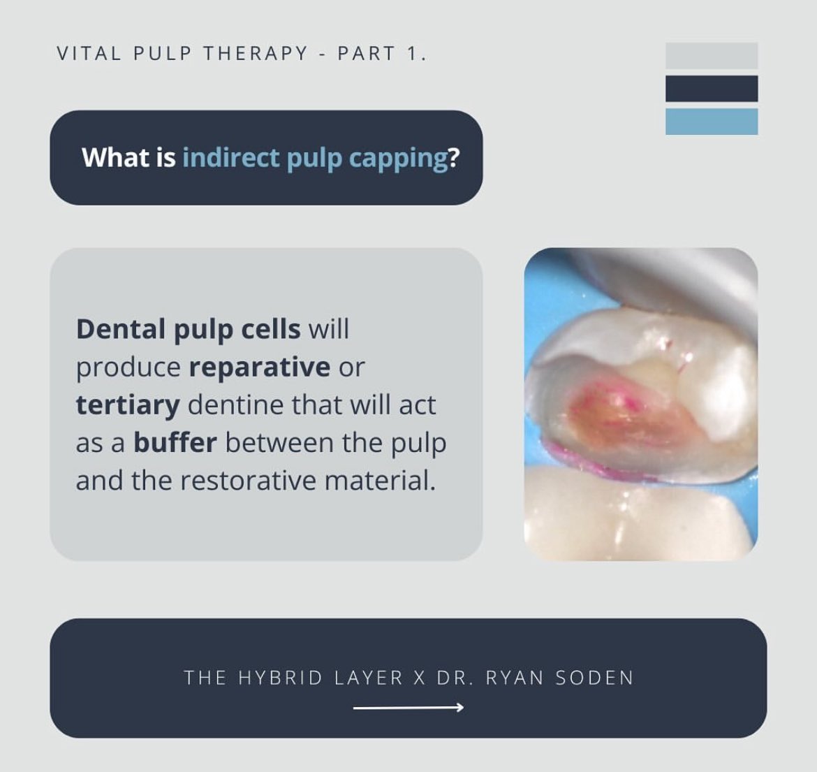 DiariesDent's tweet photo. What is indirect pulp capping ?? 👇🏼👇🏼 https://t.co/g1FvRHejQ3
