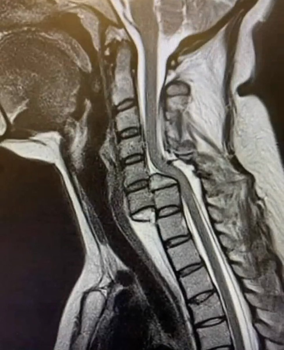 OGdukeneurosurg's tweet photo. Define Spondyloptosis? https://t.co/37epDdhV6t