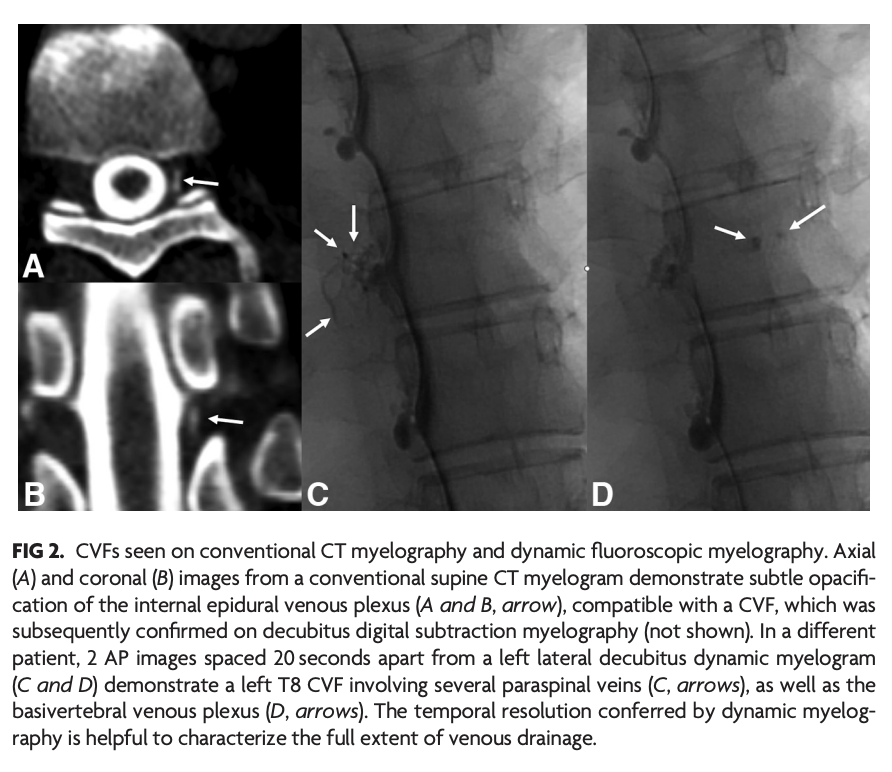 TheAJNR's tweet photo. "Myelographic Techniques for the Localization of CSF-Venous Fistulas: Updates in 2024"

#EditorsChoice @The_ASSR; @PeterGKranz; @iantmark

https://t.co/bIS95wyecx https://t.co/n9CP3jAusZ