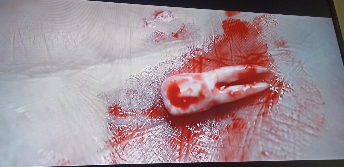 e essa cena do filme a substância que eles colocaram 2 RAIZES num INCISIVO LATERAL juro

aqui eles foram moleques demais