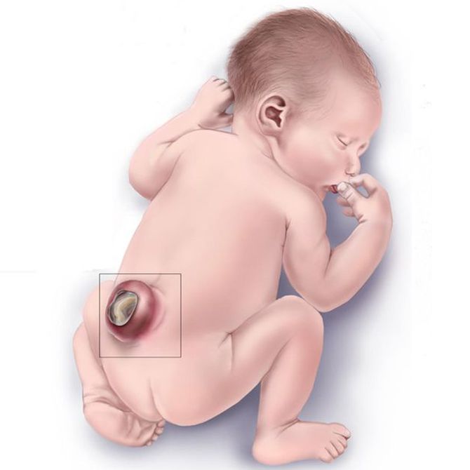 controldeldolor's tweet photo. Hoy es el Día Mundial de la Espina Bífida, es una malformación congénita donde la columna vertebral no se desarrolla normalmente en las primeras semanas del embarazo provocando daños permanentes en la médula espinal y el sistema nervioso del bebé. https://t.co/Etk3h69bwM