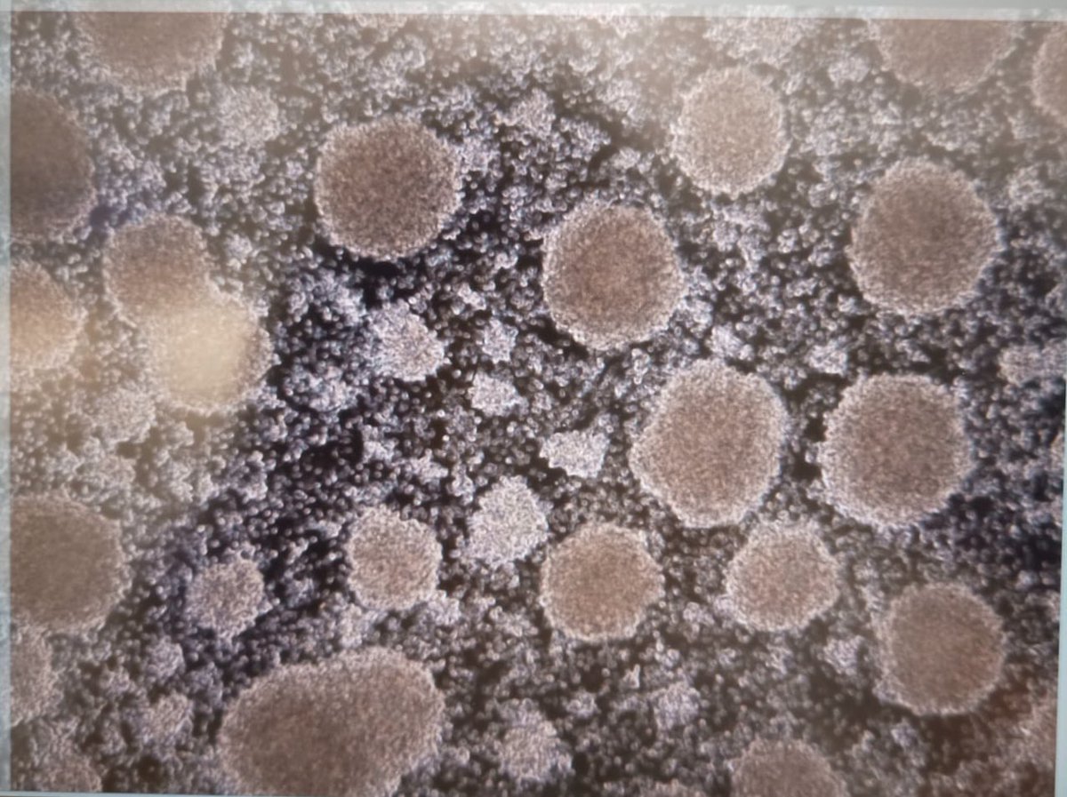 Qué ves en la foto? El producto de terapia avanzada BB-NK-001.
Avanzamos para la acreditación de la Sala Blanca de <a href="/biobizkaia/">IIS Biobizkaia</a>. Hemos realizado una leucoaféresis y purificado las células NK que se activan con citoquinas.
#celulasnk #célulasnk #inmunoterapia #terapiasavanzadas