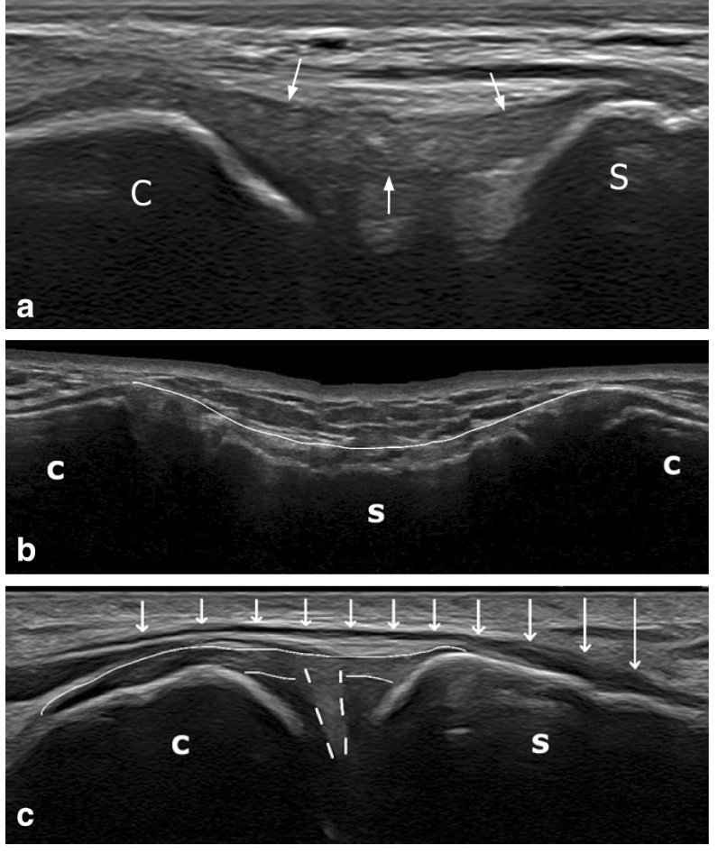 Rheumatology's tweet photo. Fantastic arricle - for those who infiltrate and scan the sc joint.

Anatomical study of the sternoclavicular joint using high-frequency ultrasound

FREE PDF

https://t.co/Xsm6Xmsq6h https://t.co/GOfKWj3jfc