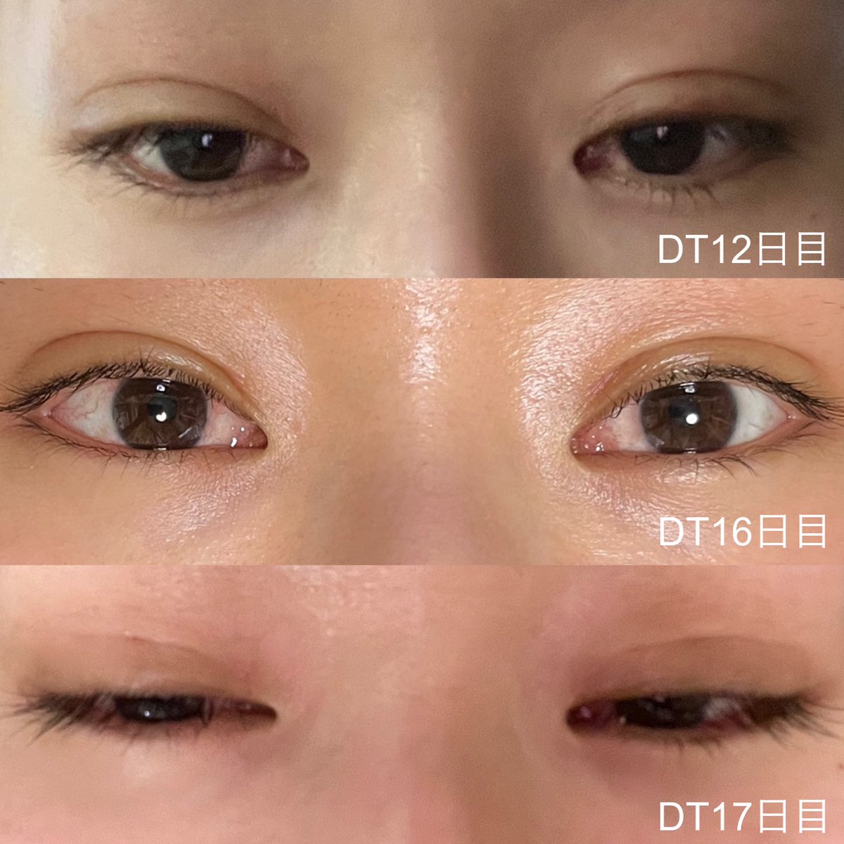 stypstvv's tweet photo. DT18日目現在の懸念点は
・ラインがやや非対称(元々右眉を上げる癖が強いと言われていた)
・傷口 線上の凹みみたいなもの
・まだ晴れてるのかややハム目？

#自然癒着　#目つき矯正　#目上切開 https://t.co/tTZF6QO2ak