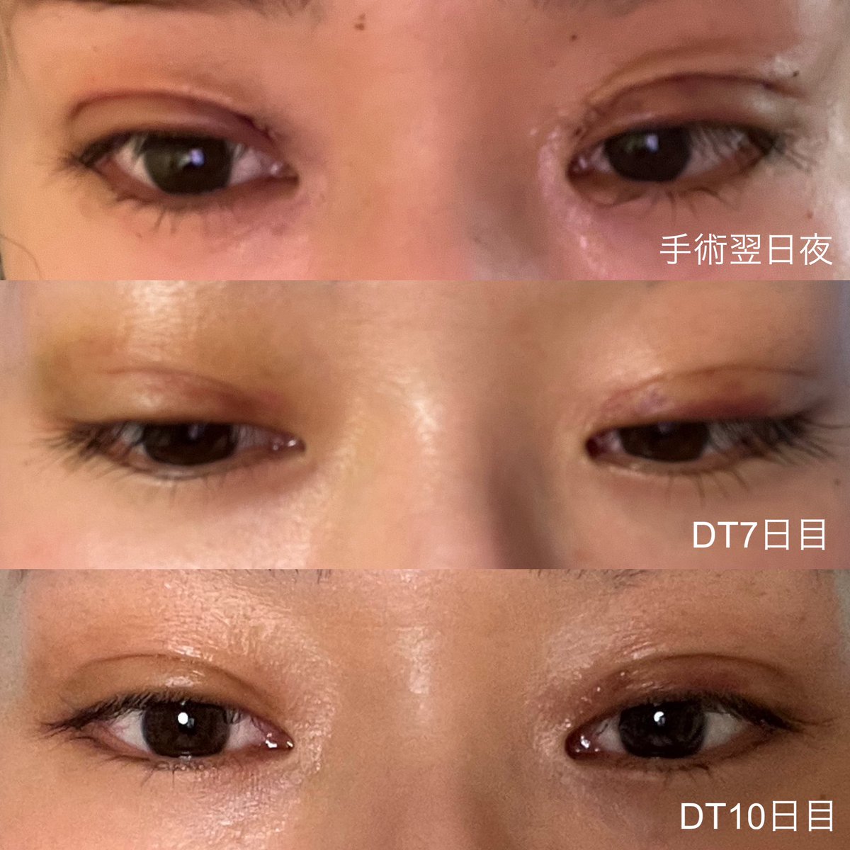 stypstvv's tweet photo. DT18日目現在の懸念点は
・ラインがやや非対称(元々右眉を上げる癖が強いと言われていた)
・傷口 線上の凹みみたいなもの
・まだ晴れてるのかややハム目？

#自然癒着　#目つき矯正　#目上切開 https://t.co/tTZF6QO2ak