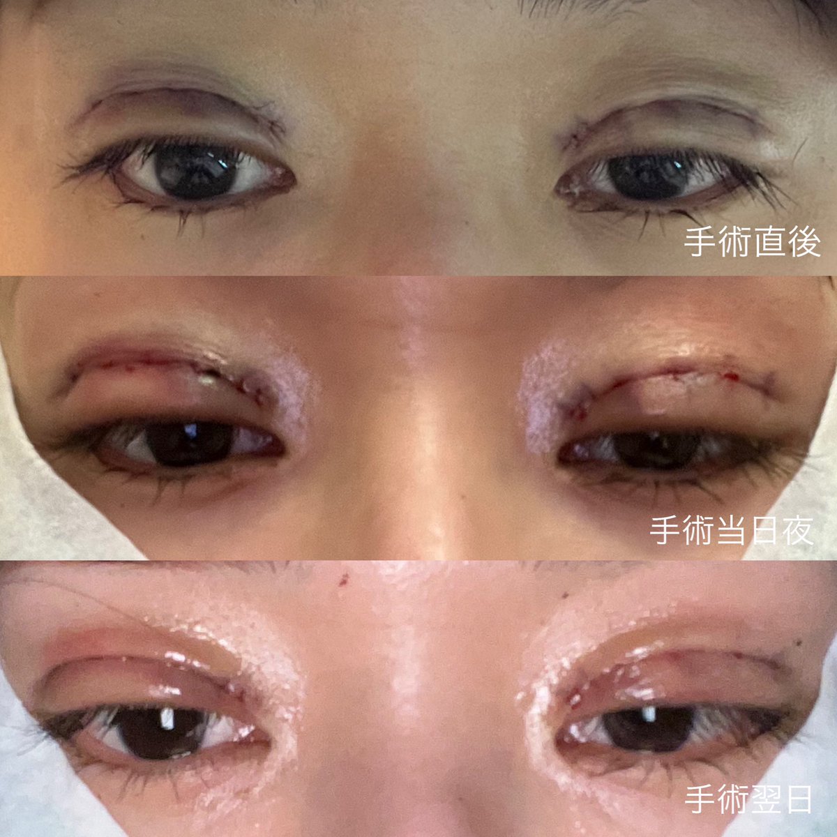 stypstvv's tweet photo. DT18日目現在の懸念点は
・ラインがやや非対称(元々右眉を上げる癖が強いと言われていた)
・傷口 線上の凹みみたいなもの
・まだ晴れてるのかややハム目？

#自然癒着　#目つき矯正　#目上切開 https://t.co/tTZF6QO2ak