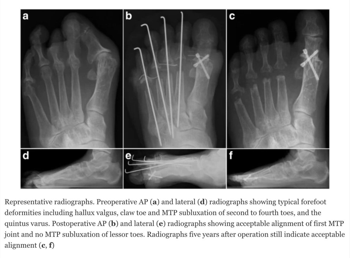 alb_giraldo's tweet photo. Approximately 90% of adult patients with long-standing #rheumatoid #arthritis develop painful #forefoot deformities that interfere with standing and walking. The #metatarsophalangeal joints are the most common sites affected, developing deformity or dislocation that frequently result in decreasing the quality of life in these patients. In severe cases ―like the one shown in the pre- and post-operative photographs―, the surgical technique of choice is the arthrodesis of the first metatarsophalangeal joint, resection #arthroplasty of the lesser metatarsal heads, and repair of fixed hammer-toe deformities with intramedullary Kirschner-wire fixation; it results in a stable repair with a high percentage of successful results at an average of six years after the procedures.
*Onodera, T., Nakano, H., Homan, K. et al. Preoperative radiographic and clinical factors associated with postoperative floating of the lesser toes after resection arthroplasty for rheumatoid forefoot deformity. BMC Musculoskelet Disord 20, 87 (2019).
🔗https://t.co/eyDPk0C5OD