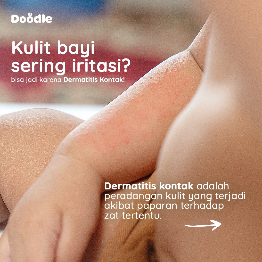 DoodleIDN's tweet photo. Si kecil sering iritasi? Jangan disepelein ya Moms🥺  Kulit si kecil yang sering iritasi bisa jadi disebabkan oleh dermatitis kontak. https://t.co/UN49XFlcSH