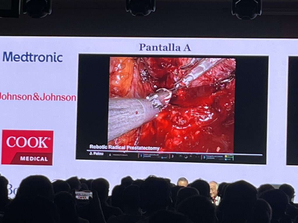 agallioli's tweet photo. @joanfundi is performing a nerve-sparing RARP with hood technique 

🔝continence &amp; neurovascular bundle preservation

⚠️ anastomosis a bit trickier due to the hood preservation

#UroONCO 
#57UroPuigvert
@57_UroPuigvert 
@AlbertoBreda1 https://t.co/LJ9u6wCuVp