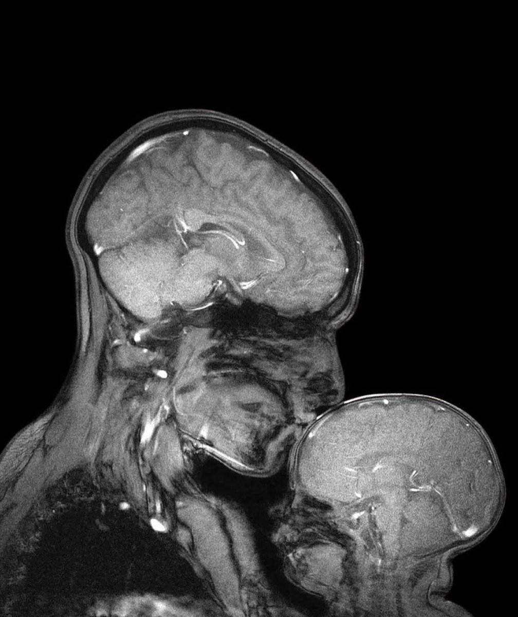 El vínculo materno-infantil es una conexión emocional y fisiológica que se establece entre la madre y el bebé durante el embarazo, parto y posparto.

La hormona oxitocina, clave en la formación de este vínculo, aumenta durante el embarazo y se libera intensamente en el parto y