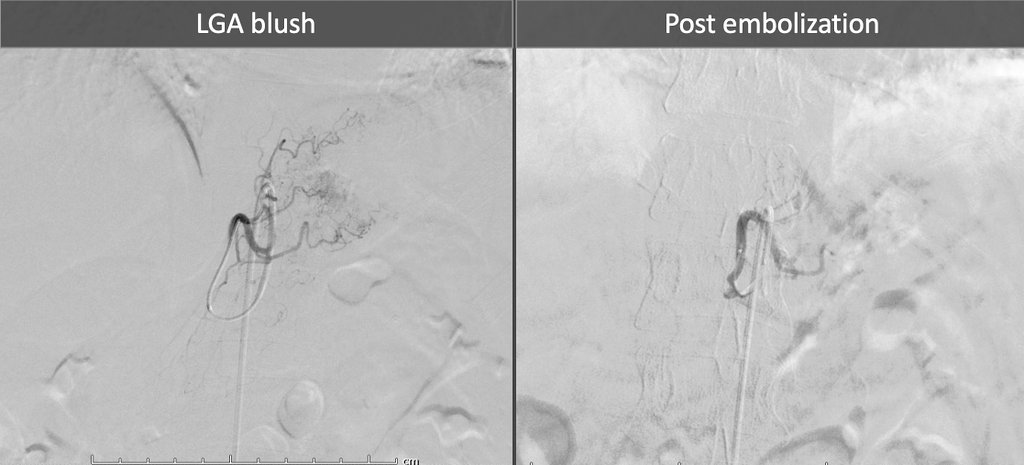 Marri_VIR's tweet photo. #bariatricembolization #IRad
40y/F, NASH+Diabetic
Obese pt struggling to loose weight

#LGAembolization for #obesity

1 month f/u:
Weight 86➡️74.5kg  ✅

Are we underutilizing this awesome #minimallyinvasive treatment for obesity?
#ISVIR #SIRspecialists #SIRRFS #Withoutascalpel https://t.co/DMPumuNGUa