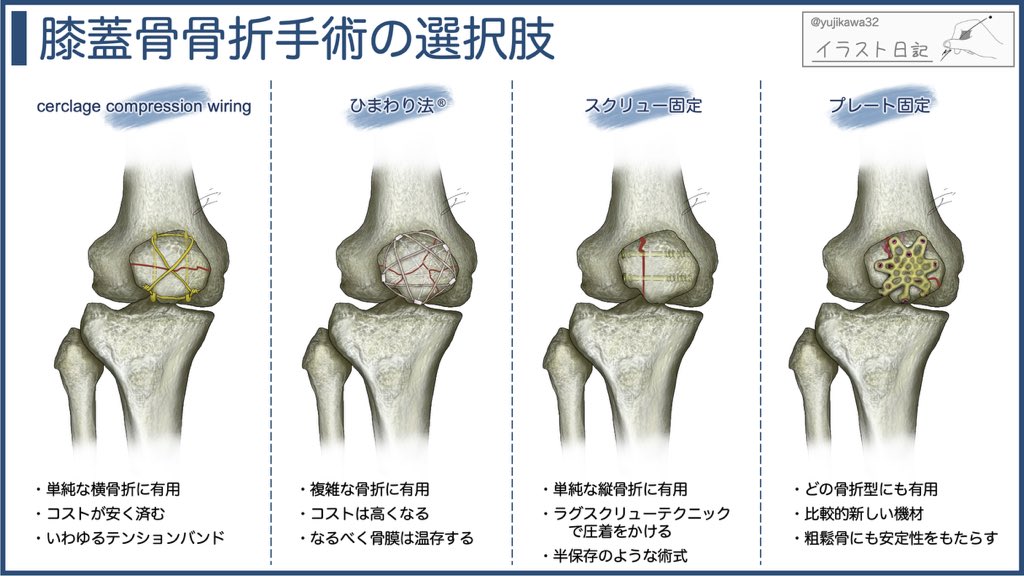 学会に向かう新幹線で久々の新作ができました。どの骨にもそうですが