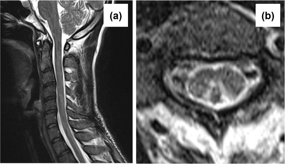 ClinicalNeuroph's tweet photo. [Myelopathy] Li et al.: "We recommend that both SSEP and CMCT be routinely performed in patients with myelopathy to accurately identify affected spinal segments, including those not apparent on neuroimaging, and to monitor the recovery process."

https://t.co/5L8qzthORt

SSEP: somatosensory evoked potentials
CMCT: central motor conduction time