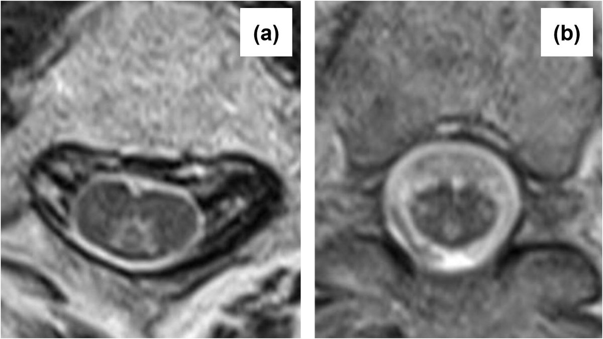 ClinicalNeuroph's tweet photo. [Myelopathy] Li et al.: "We recommend that both SSEP and CMCT be routinely performed in patients with myelopathy to accurately identify affected spinal segments, including those not apparent on neuroimaging, and to monitor the recovery process."

https://t.co/5L8qzthORt

SSEP: somatosensory evoked potentials
CMCT: central motor conduction time