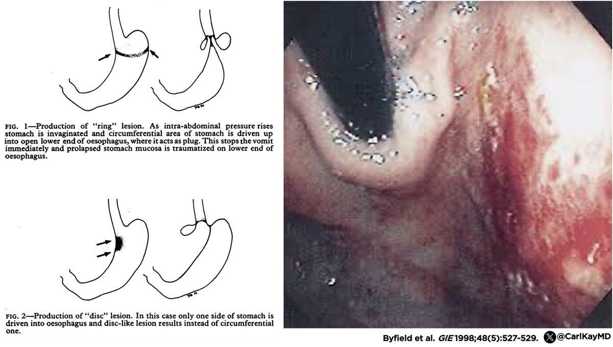 Carl Kay, MD (@carlkaymd) on Twitter photo Axon-Clarke Gastropathy
▪️Cause of hematemesis 🤮🩸
▪️Localized red mucosa near GEJ
▪️Retrograde intussusception of stomach
▪️Occurs during retching/vomiting
▪️Mimics Mallory-Weiss presentation
▪️First described by Axon & Clarke in 1975
🔗 ncbi.nlm.nih.gov/pmc/articles/P…
#GITwitter Axon-Clarke Gastropathy
▪️Cause of hematemesis 🤮🩸
▪️Localized red mucosa near GEJ
▪️Retrograde intussusception of stomach
▪️Occurs during retching/vomiting
▪️Mimics Mallory-Weiss presentation
▪️First described by Axon & Clarke in 1975
🔗 ncbi.nlm.nih.gov/pmc/articles/P…
#GITwitter