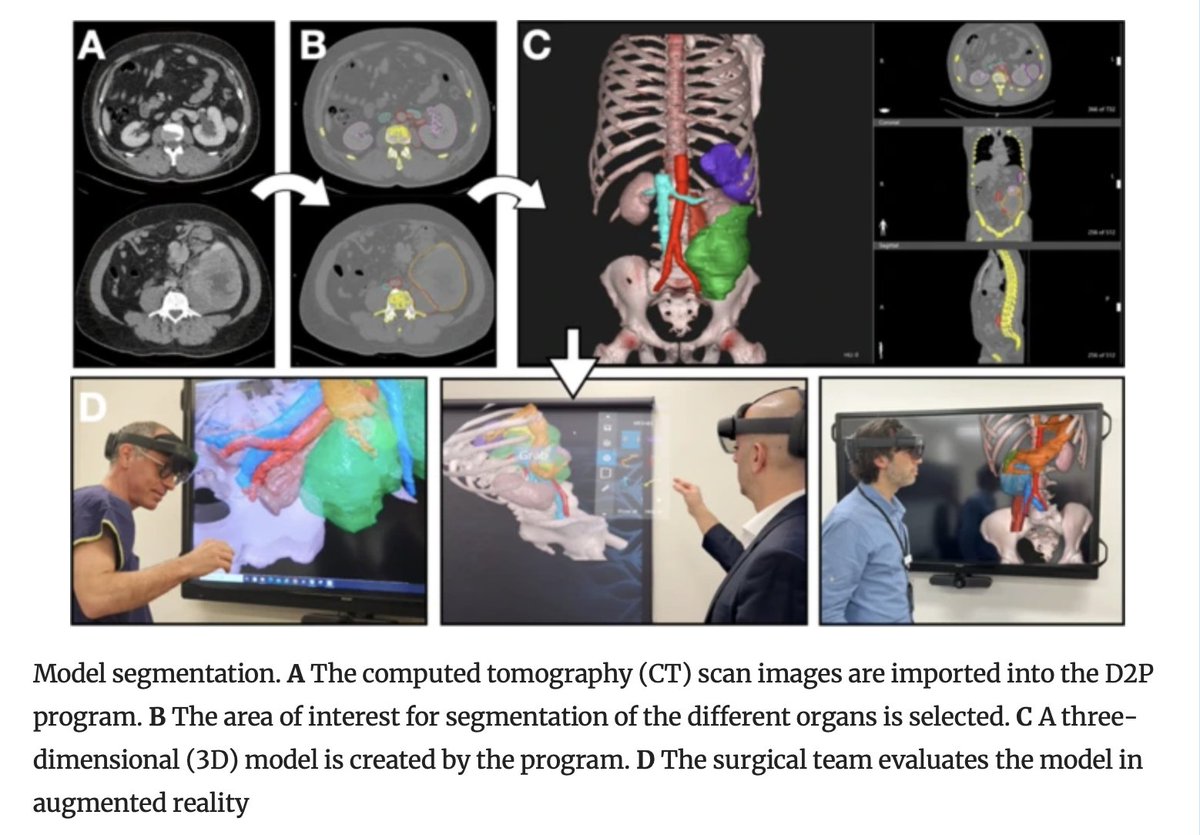 Annals of Surgical Oncology (@annsurgoncol) on Twitter photo October Issue: 3D-SARC: A Pilot Study Testing the Use of a 3D Augmented-Reality Model with Conventional Imaging as a Preoperative Assessment Tool for #SurgicalResection of Retroperitoneal #Sarcoma <a href="/eyal_more/">Eyal Mor</a> <a href="/davidgyorki/">David Gyorki</a>
rdcu.be/dXdGG
<a href="/MeredithGunder/">Meredith Gunder, MD</a>
<a href="/SyedAAhmad5/">Syed A. Ahmad</a> October Issue: 3D-SARC: A Pilot Study Testing the Use of a 3D Augmented-Reality Model with Conventional Imaging as a Preoperative Assessment Tool for #SurgicalResection of Retroperitoneal #Sarcoma <a href="/eyal_more/">Eyal Mor</a> <a href="/davidgyorki/">David Gyorki</a>
rdcu.be/dXdGG
<a href="/MeredithGunder/">Meredith Gunder, MD</a>
<a href="/SyedAAhmad5/">Syed A. Ahmad</a>