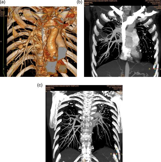 MoreXGrok's tweet photo. 35-yr-old male pt with a past hx of tb of lung, which was treated earlier with ATT, had presented with a history of recurrent hemoptysis. 

Had undergone bronchial artery embolization earlier at a different hospital

 He, however, continued to have recurrent hemoptysis.

CT pulmonary angiogram👇

Thoughts?