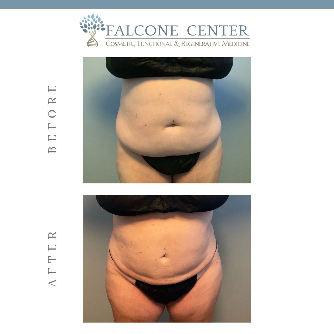 FalconeCenter's tweet photo. Menopause "muffin top" be gone this Halloween with a Vaser liposuction procedure from Dr Falcone.
Schedule your FREE Falcone Center consultation in October and save up to $500 on a November liposuction procedure.  
#philadelphia #philly #liposuction #mommymakeover #lipo #medspa https://t.co/Y3FZePCgtz