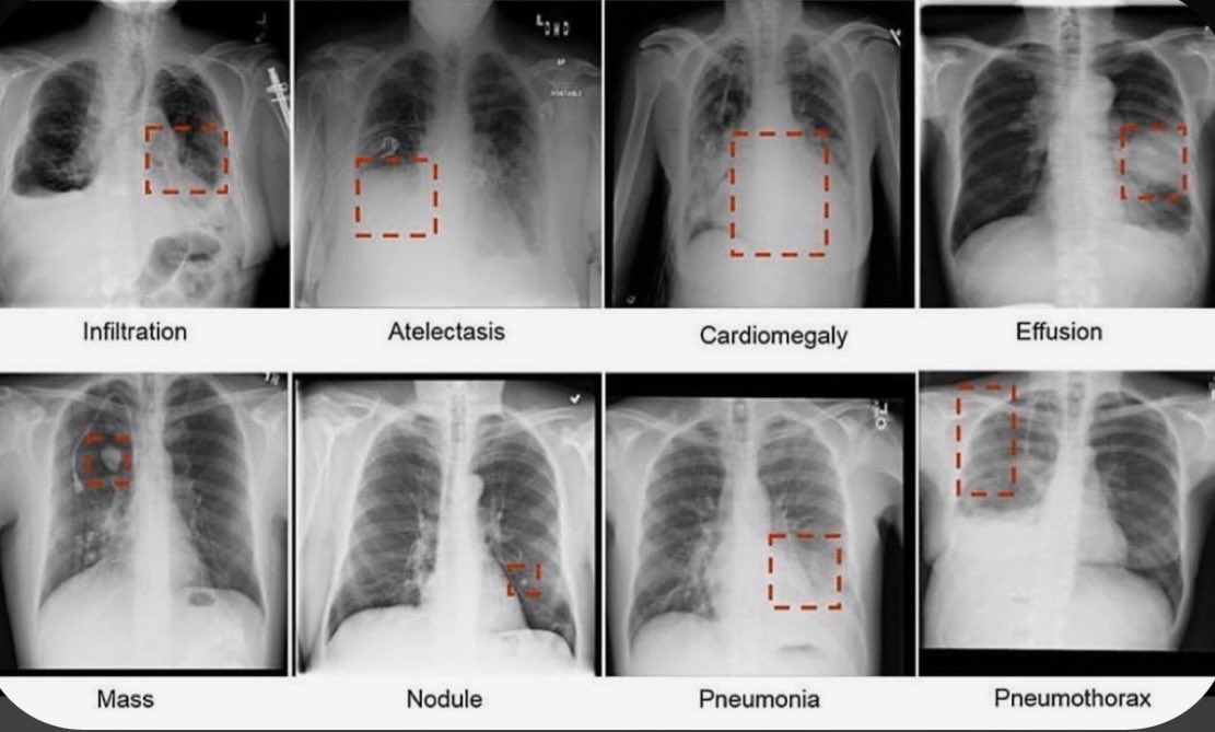AB_drmd's tweet image. صورة جميلة توضح علامات لأمراض مهمه تقدر تشخصها عن طريق اشعة الصدر/CXR: