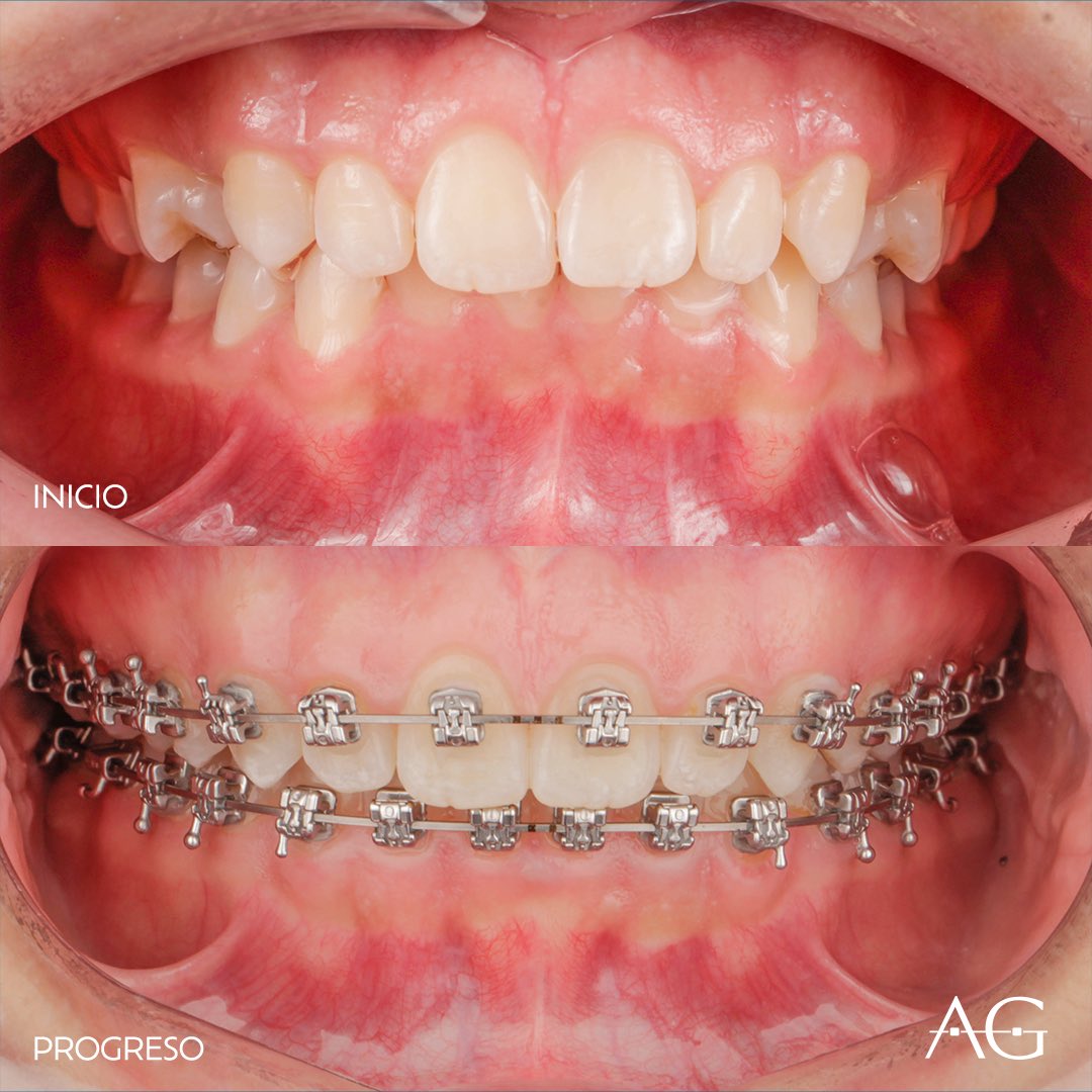 dr_galarzac's tweet photo. Con cada visita, se siente la magia del cambio: los dientes se alinean, la confianza crece y la sonrisa se ilumina.

Al final, no solo se trata de una boca hermosa, sino de la transformación de una vida. ¡Tu sonrisa merece brillar!

Contáctanos  👉🏻 📲 0986281693 https://t.co/cxkpjCKpYw