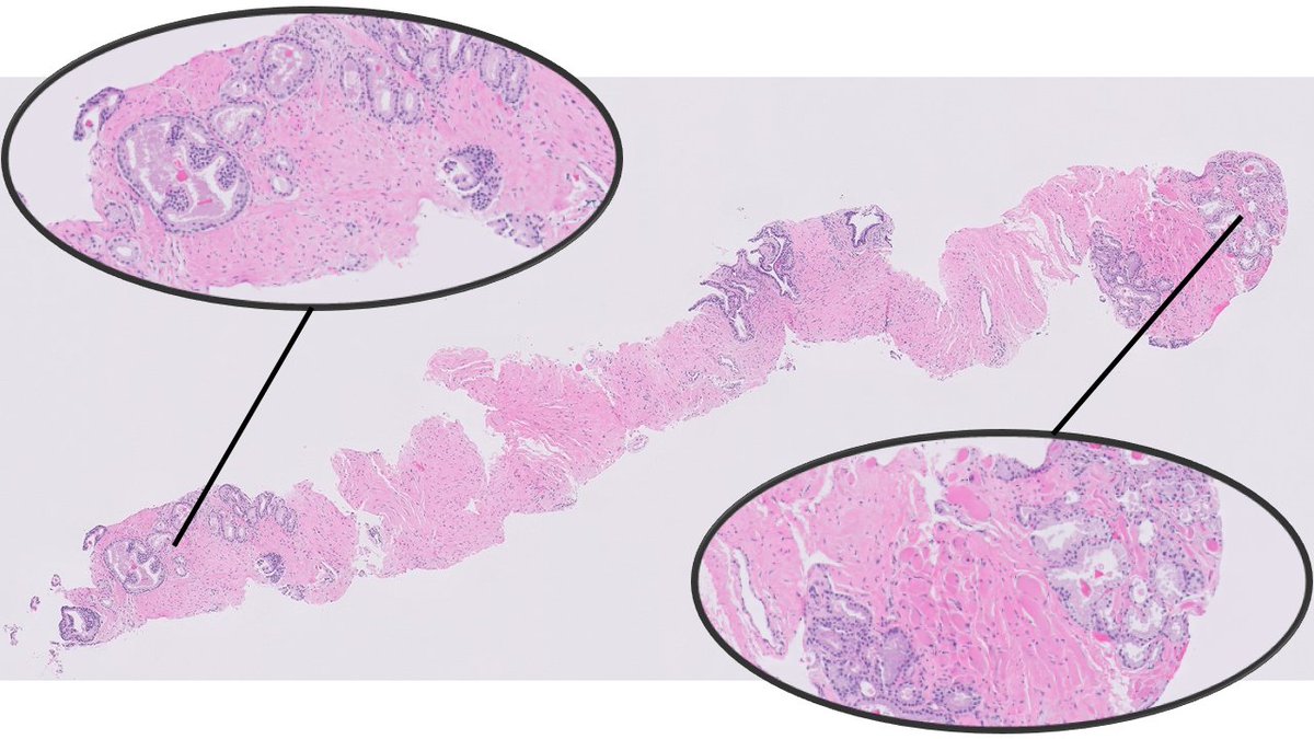 #GUpath prostate biopsy:

controversies in applying volume of core involved:

❓95% of core involved by prostate cancer?
🆚
❓15% of core, discontinuously involved

there's data on both sides...so use your judgement and explain how you arrived at your reporting!