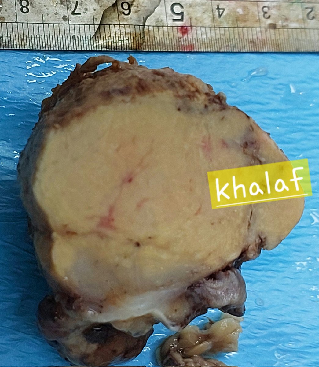 khalafalla71's tweet photo. Maxillary tumor-like lesion.
#ENTpath #Pathology #PathTwitter https://t.co/iDC0k2cLGQ
