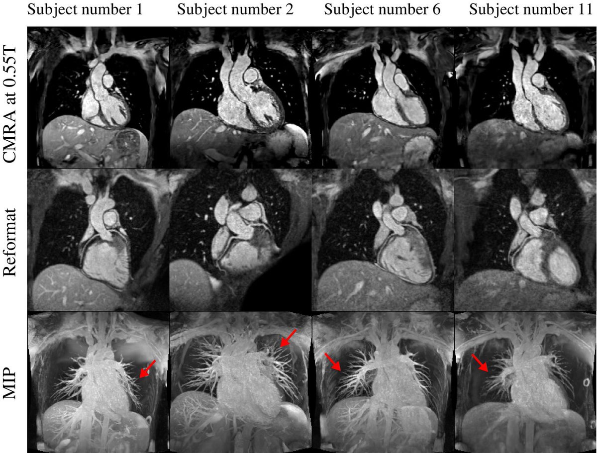 Carlos Castillo Passi (@carlos_cp92) on Twitter photo Check out our new paper on low-field cardiac MRI🫀🧲:
"Highly efficient image navigator based 3D whole-heart cardiac MRA at 0.55T"
And see some very nice low-field CMRA images! 😁
<a href="/iHEALTHMilenio/">iHEALTH</a> <a href="/KCL_CardiacMR/">KCL Cardiac MRI</a> <a href="/MRI_CPrieto/">Claudia Prieto</a> <a href="/rbotnar/">Rene Botnar</a>
Paper: onlinelibrary.wiley.com/doi/10.1002/mr… Check out our new paper on low-field cardiac MRI🫀🧲:
"Highly efficient image navigator based 3D whole-heart cardiac MRA at 0.55T"
And see some very nice low-field CMRA images! 😁
<a href="/iHEALTHMilenio/">iHEALTH</a> <a href="/KCL_CardiacMR/">KCL Cardiac MRI</a> <a href="/MRI_CPrieto/">Claudia Prieto</a> <a href="/rbotnar/">Rene Botnar</a>
Paper: onlinelibrary.wiley.com/doi/10.1002/mr…