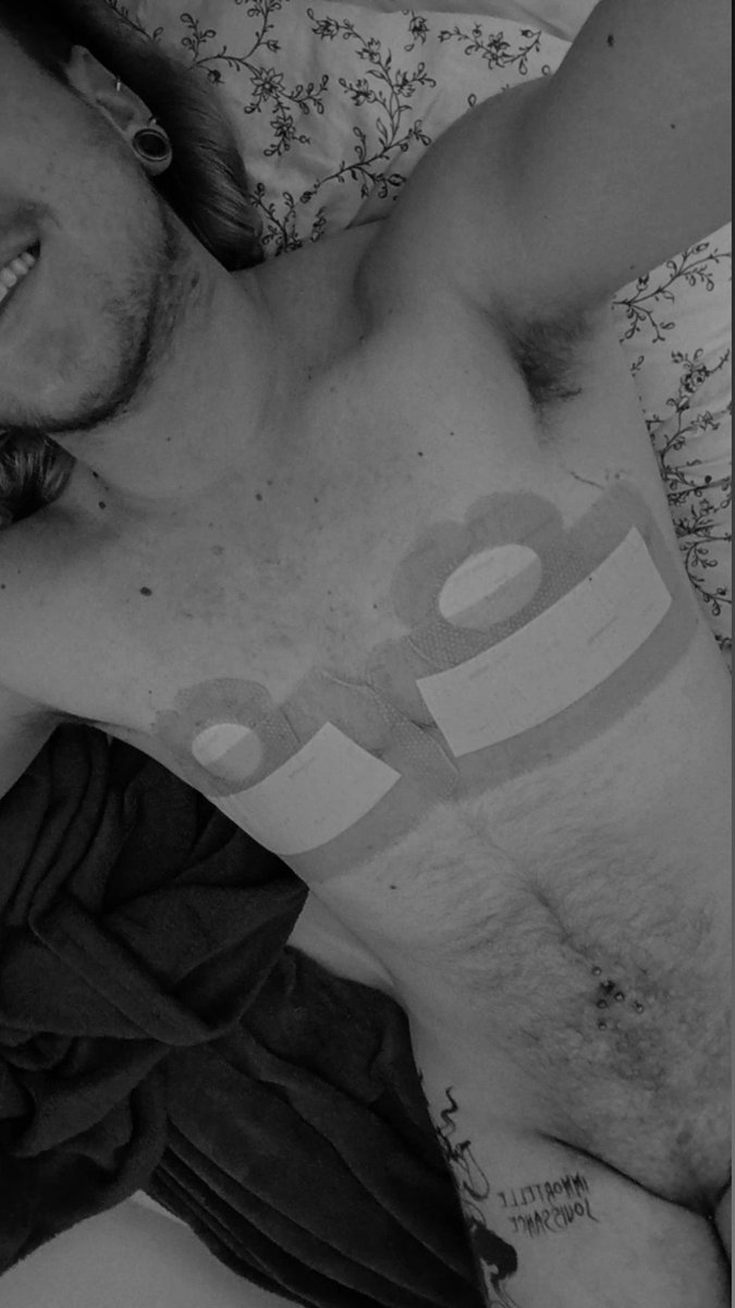 gab_puppy's tweet photo. One week post op #mastectomie https://t.co/2V5MYYZH24