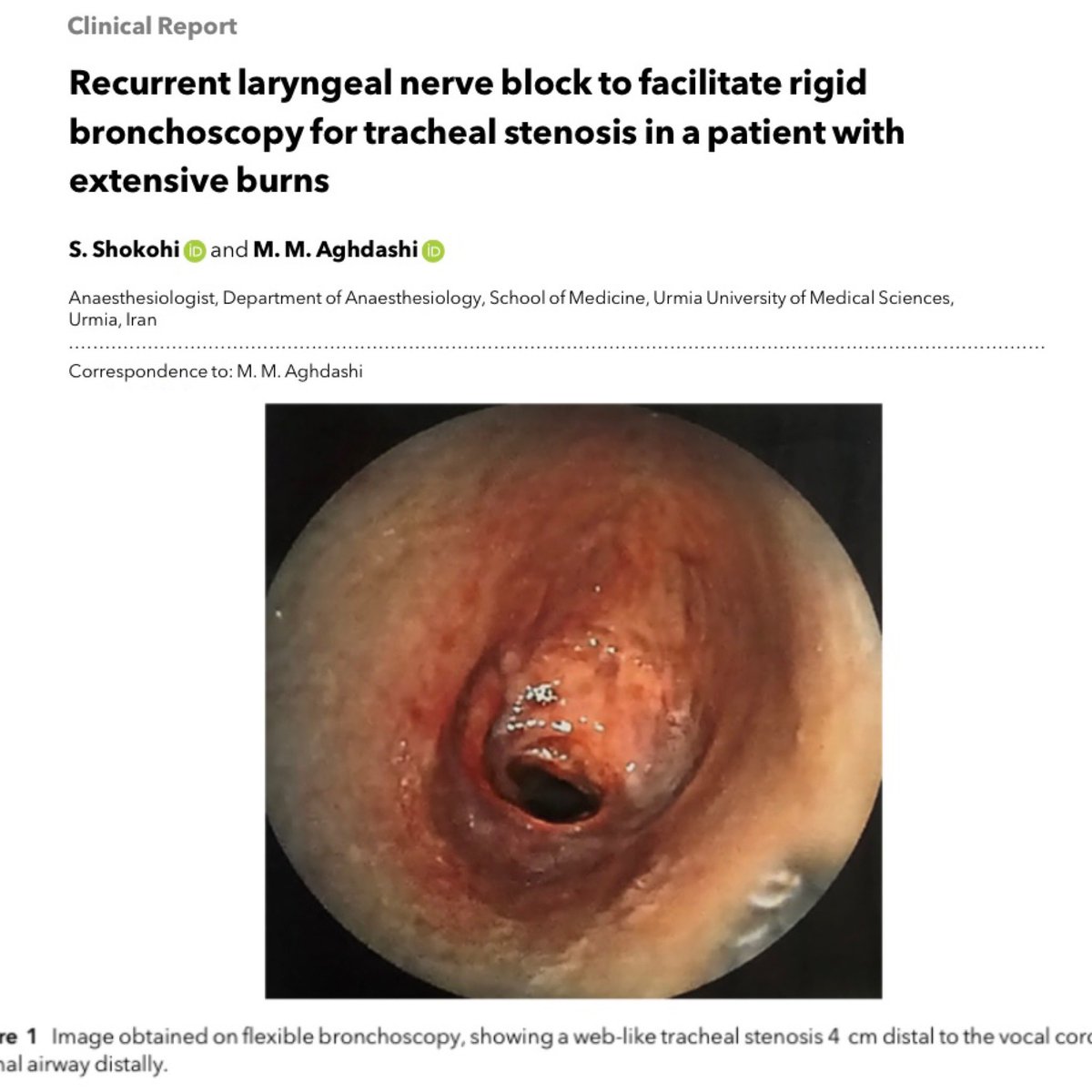 Anaes_Reports's tweet image. Interesting case report on management of a patient with burns and tracheal stenosis causing airway compromise using a recurrent laryngeal nerve block to avoid neuromuscular blockade. Anyone else used regional for a case like this? #freeforaweek #blocktober24 @jeffgadsen