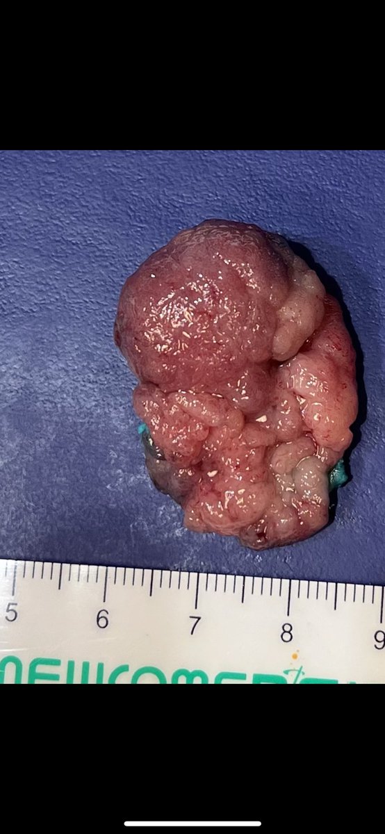 Sanmeet Singh MD (@sanmeetsingh07) on Twitter photo Patient referred to our practice from colorectal surgery.
๐ En bloc removal via endosubmucosal dissection ( ESD)
๐ HybdridKnife
๐ Pathology : TVA with HGD
๐ Negative margins
<a href="/ASGEendoscopy/">ASGE GI Endoscopy</a> <a href="/bostonsci/">Boston Scientific</a> <a href="/Olympus_Corp/">Olympus</a>
#GItwitter Patient referred to our practice from colorectal surgery.
๐ En bloc removal via endosubmucosal dissection ( ESD)
๐ HybdridKnife
๐ Pathology : TVA with HGD
๐ Negative margins
<a href="/ASGEendoscopy/">ASGE GI Endoscopy</a> <a href="/bostonsci/">Boston Scientific</a> <a href="/Olympus_Corp/">Olympus</a>
#GItwitter