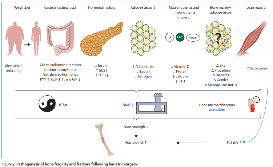 Although #weightloss in people with #obesity has many health benefits, it can also have adverse #skeletal effects, with increased #bone loss and #fracture risk thelancet.com/journals/landi…  
#osteoporosis #BoneHealth #BariatricSurgery 
#GLP-1 receptor agonists