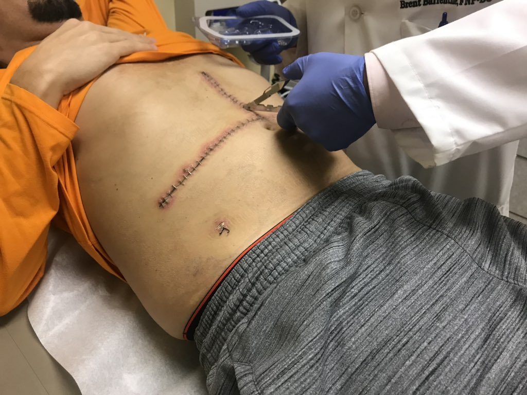 My liver donor passed away six years ago today. I’m eternally grateful to the family whose loss and decision to #DonateLife transformed my life. 

Many thanks to 𝐚𝐥𝐥 the life-saving living donors and families of deceased organ &amp; tissue donors out there. 💚