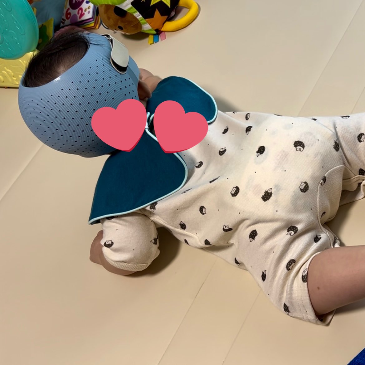 ____U6o6U____'s tweet photo. 1ヶ月半経過!検診行ってきた⛑中等症になってた🥹見た目はまだ歪みはあるなって感じだけど、丸みが出てきてた!クッションも取れたし、また1ヶ月頑張ろ💪🏻
#赤ちゃんの頭のかたち
#ベビーバンド
#babyband
#ヘルメット治療
#斜頭症 https://t.co/dE8g3am9VD
