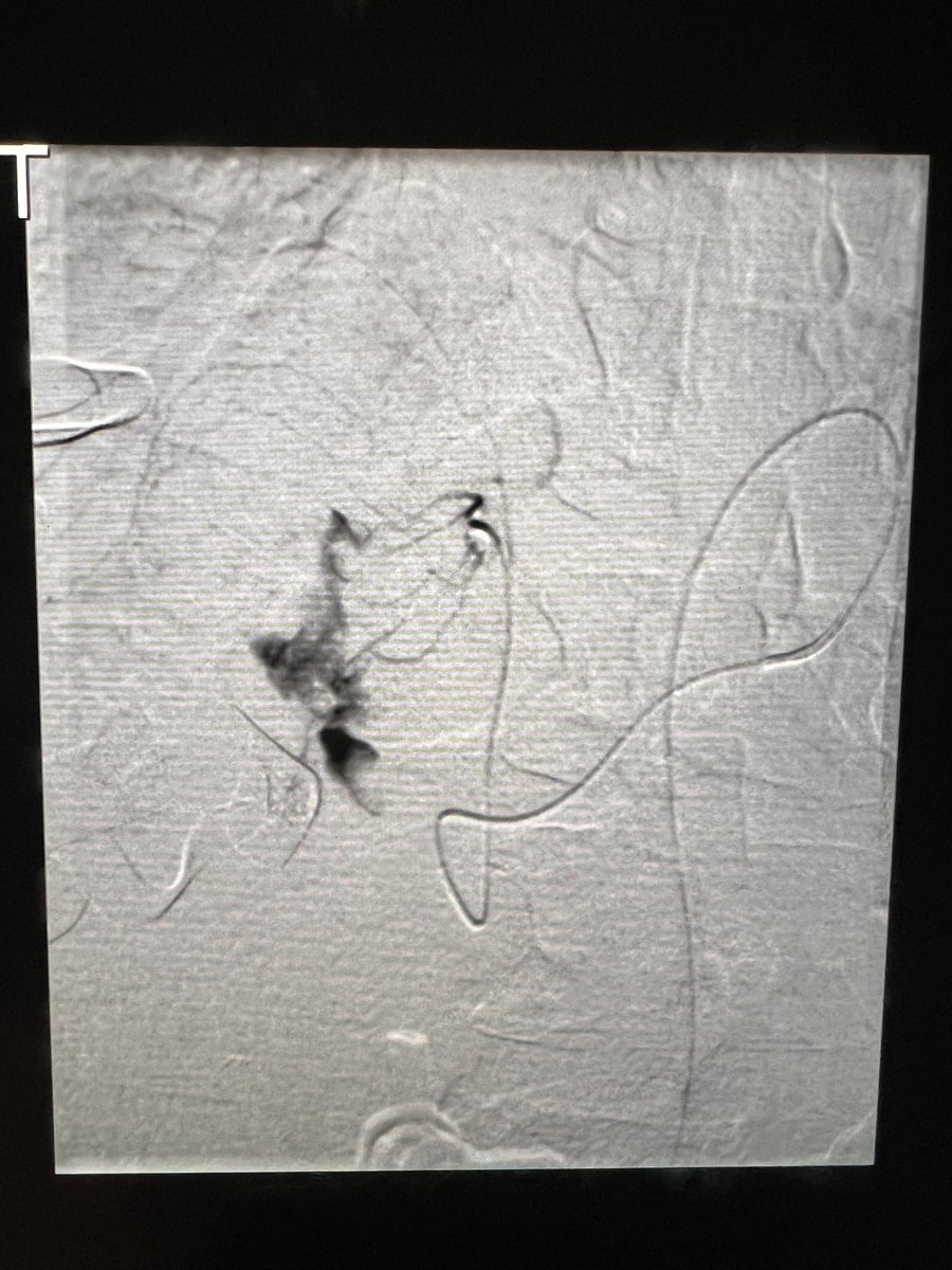 ChengaziMD's tweet photo. When a patient goes from bleeding through a packed abdomen on massive transfusion and with 2 full poles of infusion pumps, to off pressors and stable within 8h - #VIRad has worked its magic, surgeon approved #withoutascalpel https://t.co/I20SZCWiPA