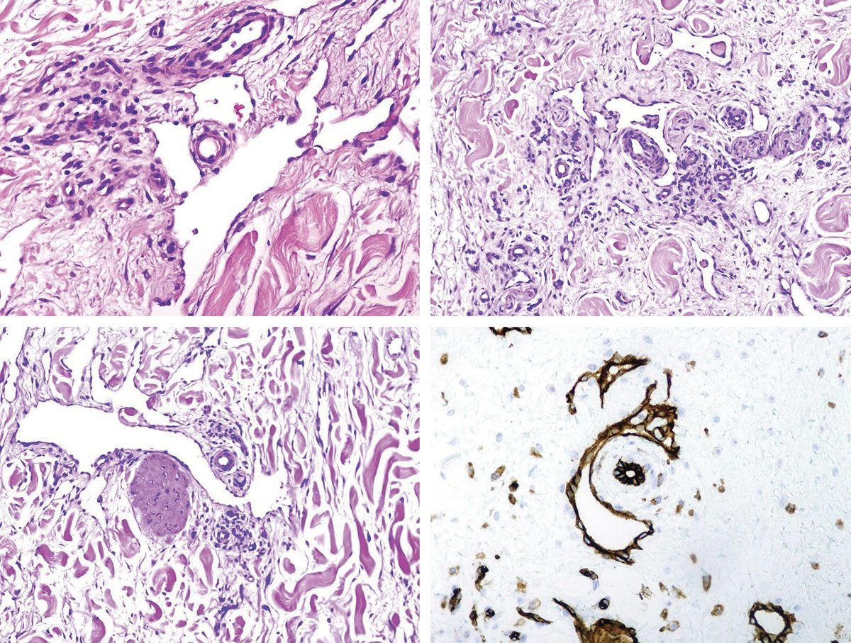 AJDP_Journal's tweet image. #ThrowbackThursday 

In 2010, @ngelFernndezFl1 described promontory sign in reactive benign vascular proliferation

Initially described in Kaposi sarcoma, the sign is not considered pathognomonic anymore and has been found in angiosarcoma and benign vascular tumors.