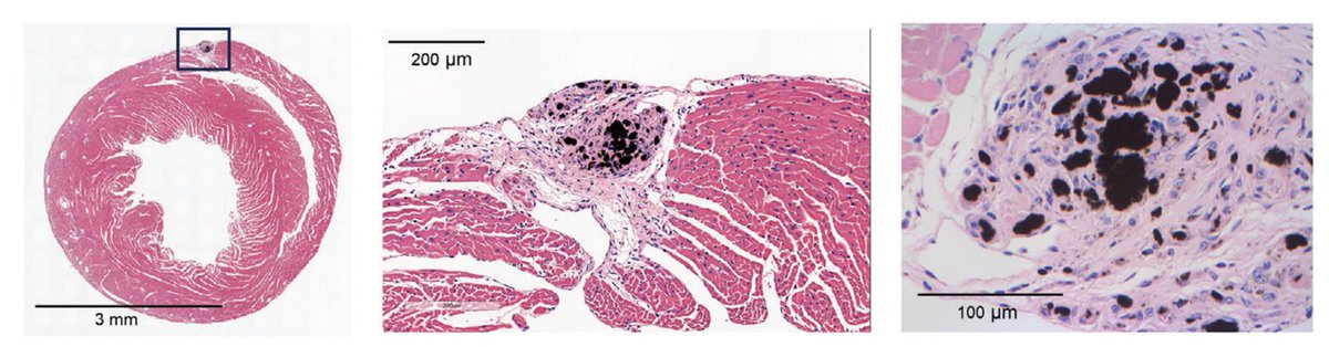 davis_ctrl's tweet image. Carbon nanotubes create lesions that closely resemble sarcoid. Sixty days after injecting them into the heart, we observed typical sarcoid granuloma histiocytes co-localizing with the nanotubes (black markings). 🔗doi: 10.1002/adbi.202400238
