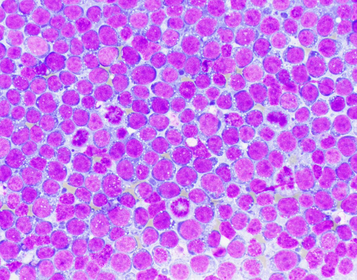HubertLauMD's tweet photo. Does it get more classic than this? #HemePath https://t.co/Rijpik7IPn