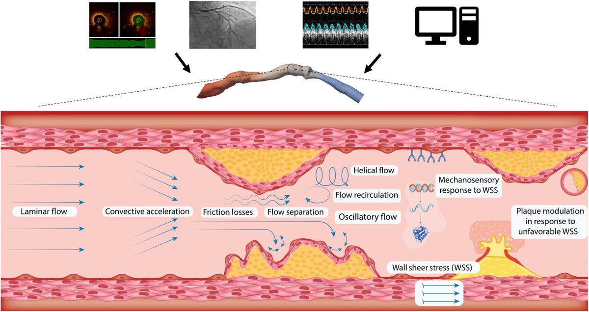 lu_mansur's tweet photo. #Coronary blood flow is shaped by vessel geometry and cardiac timing. Computational techniques reveal disturbed flow patterns in coronary disease, but clinical use is limited. Methods and trials are needed. #AHAJournals #Review https://t.co/nIANmfWOMB https://t.co/7CP120Q8p7