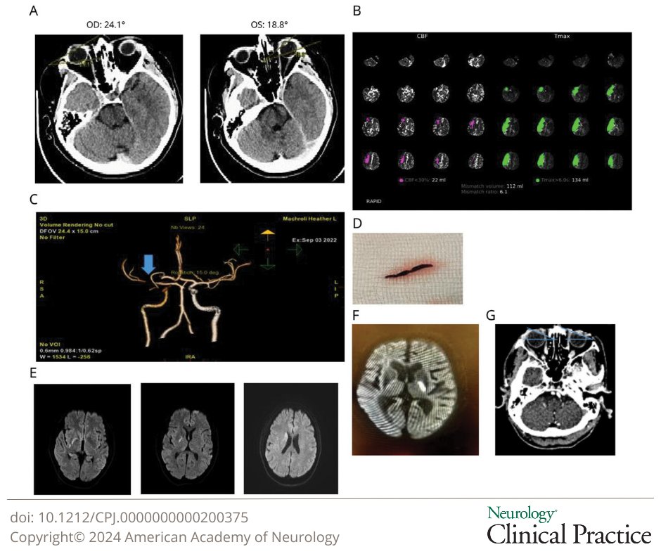 NeurologyCP's tweet photo. Radiographic Horizontal Conjugate Gaze Deviation: Clinical Correlates https://t.co/VdWfaZR9VN

#NeuroTwitter https://t.co/nRqowWEwoY