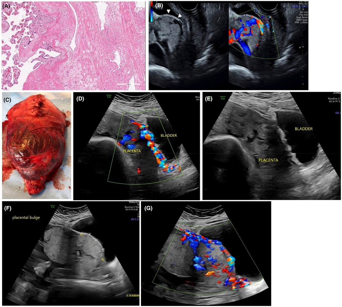 ACTA ObGyn Scand (@aogs_tweets) on Twitter photo The use of a standardized sonographic checklist had a high sensitivity and good specificity for the detection of PAS in this prospective cohort of well-classified PAS cases. <a href="/drscorcoran/">Siobhán Corcoran</a>
doi.org/10.1111/aogs.1… The use of a standardized sonographic checklist had a high sensitivity and good specificity for the detection of PAS in this prospective cohort of well-classified PAS cases. <a href="/drscorcoran/">Siobhán Corcoran</a>
doi.org/10.1111/aogs.1…