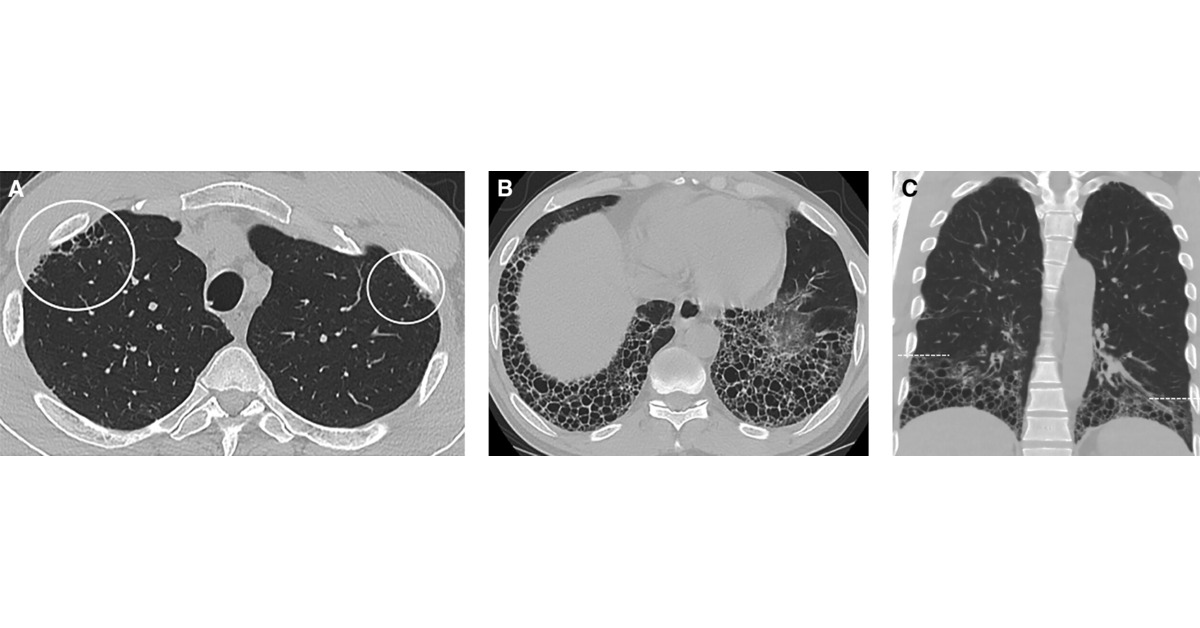 Annals of the ATS (@annalsats) on Twitter photo Telltale Signs of Lower Lobe Pulmonary Fibrosis
<a href="/atscommunity/">American Thoracic Society (ATS)</a>
🔗 tinyurl.com/3tz6hcvb Telltale Signs of Lower Lobe Pulmonary Fibrosis
<a href="/atscommunity/">American Thoracic Society (ATS)</a>
🔗 tinyurl.com/3tz6hcvb