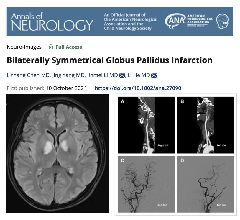 Can you get bilateral symmetric globus pallidus strokes? Yep. It is pretty darn rare especially with dissections. Chen and colleagues detail a really nice case from their practice in a new issue of Annals of Neurology <a href="/TheNewANA1/">American Neurological Association</a>.
Key Points:
- What is the blood supply to the