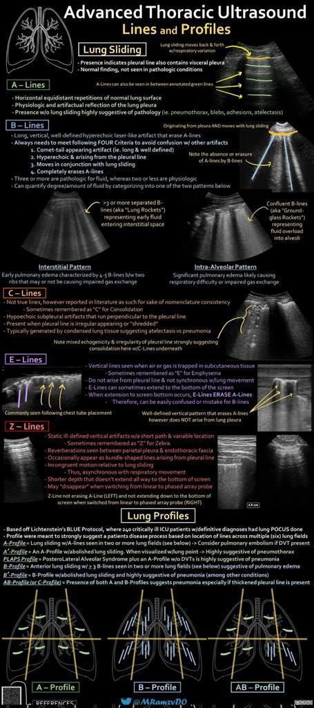 🔍 ¿Qué son las líneas en ultrasonido pulmonar? 🫁 ¡Aquí te lo explico! 📖👇

1.Deslizamiento Pleural (Lung Sliding) 🌬️
•Presencia: Indica que la pleura visceral está en contacto con la pleura parietal. Es un signo normal y su ausencia puede sugerir patologías como neumotórax.